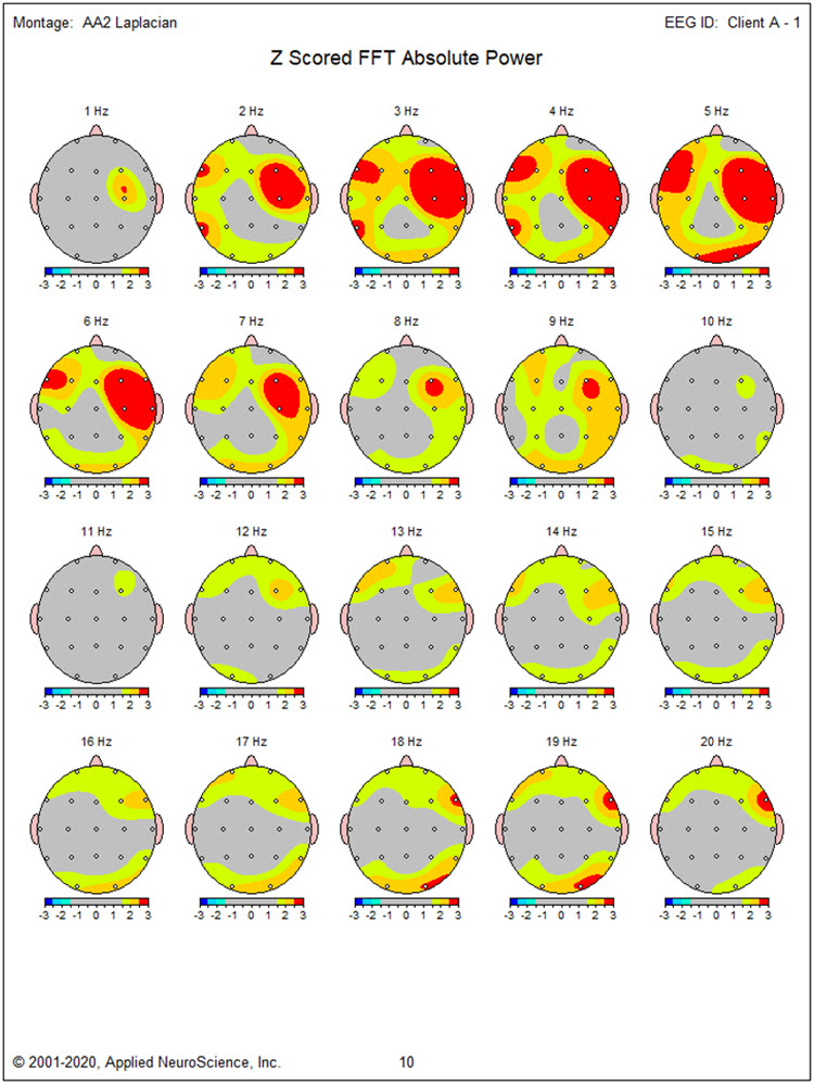 Z-scored FFT absolute power Laplacian montage showing excess activity from 2-9 Hz